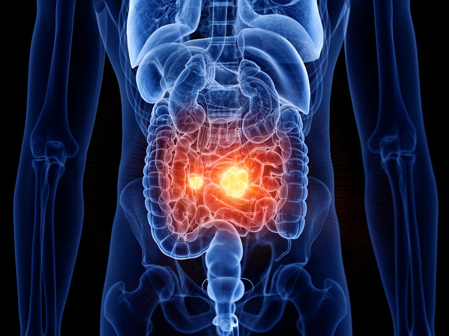 3d rendered medically accurate illustration of small intestine cancer